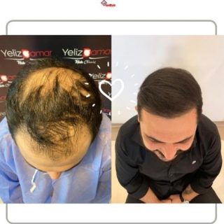 Hair Transplant Results Before and After Hair Transplantation